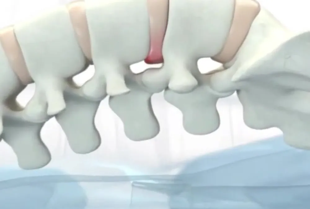 Vista 3D anatómica de columna vertebral mostrando una hernia discal (segmento rojo) entre las vértebras, base biomecánica del tratamiento SDV